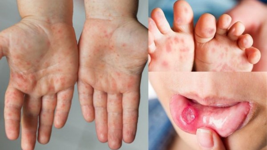 Hanoi sees fivefold jump in hand-foot-mouth disease cases