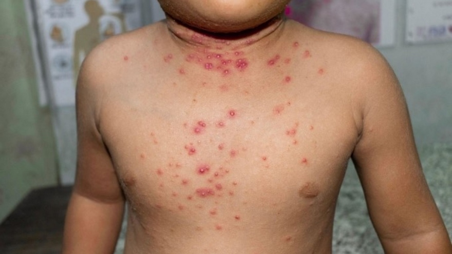 Vietnam records four monkeypox cases