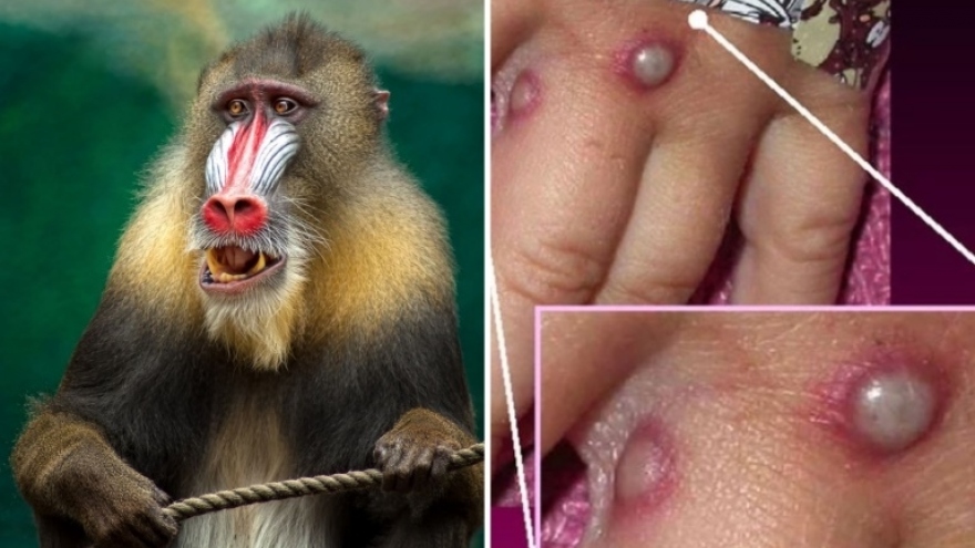 Three monkeypox cases recorded in Mekong Delta province