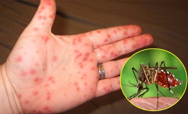 Hanoi still at high risk of dengue fever spread despite decline in cases