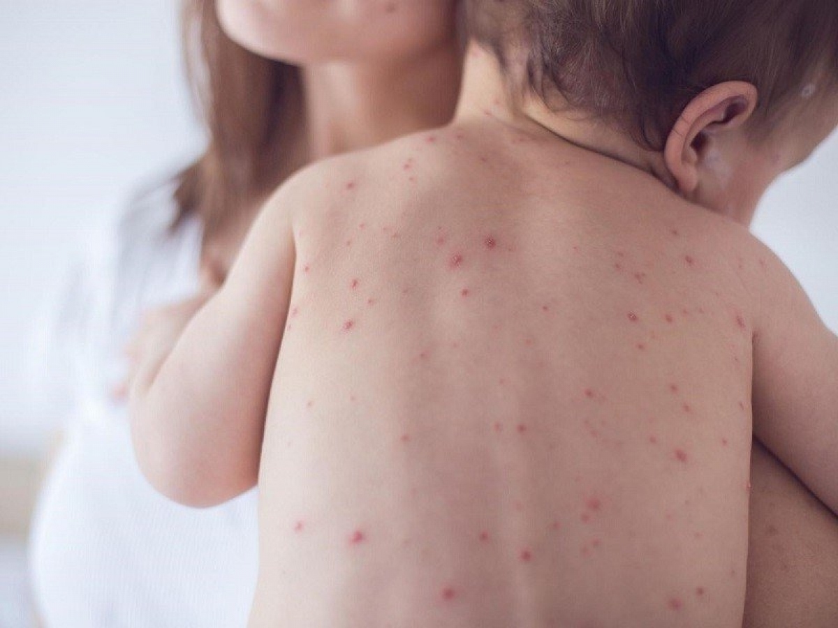 Doctors warn of abnormal rise in chickenpox cases this summer