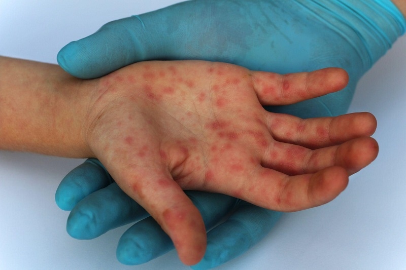 56 monkeypox cases recorded in Vietnam