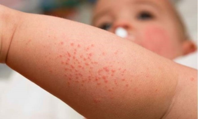Hanoi capital sees first measles case this year
